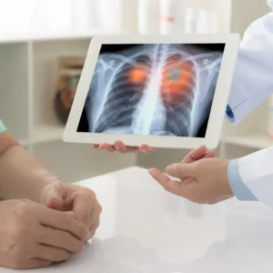 X-Ray of Lung Damage